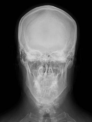 Front skull view