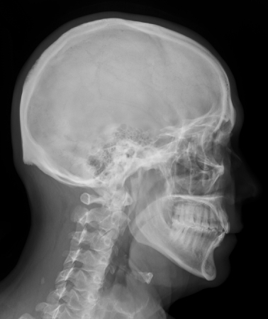 Side skull view